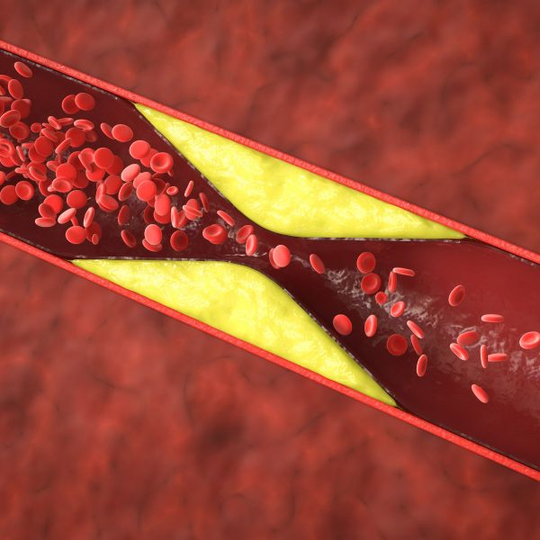 high cholesterol your bones