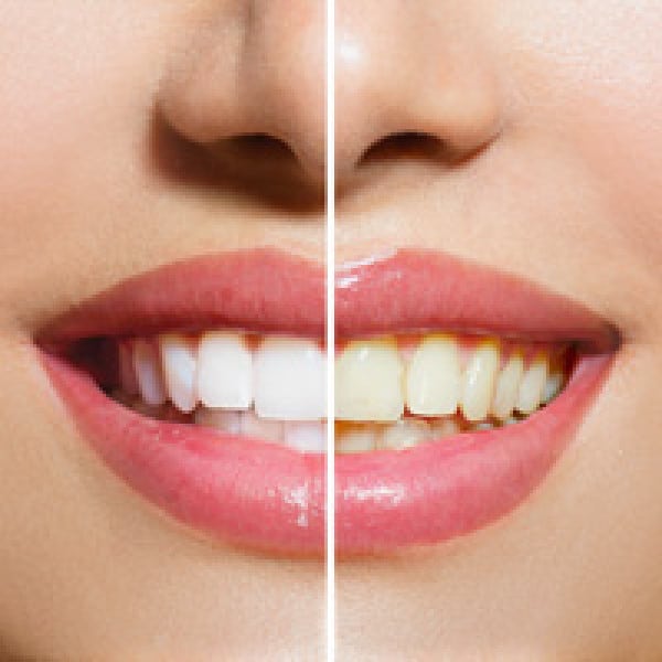 9 foods whiten teeth reverse bone loss