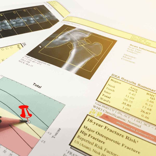 All About Bone Turnover Markers
