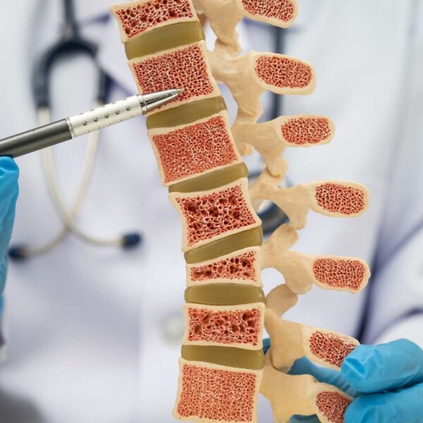 Beyond DXA Scans: A New Way To Measure Bone Tensile Strength May Predict Fractures Beyond DXA Scans A New Way To Measure Bone Tensile Strength May Predict Fractures