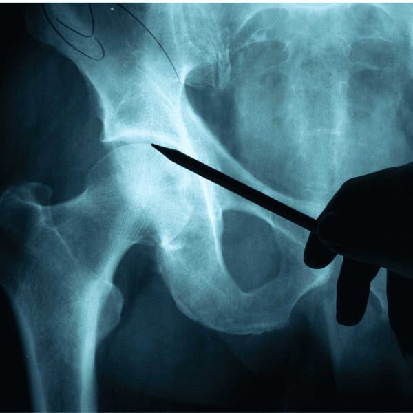 How Osteoporosis Drugs Cause Disruptions Of Vital Communication Between Bone Cells How Osteoporosis Drugs Cause Disruptions Of Vital Communication Between Bone Cells