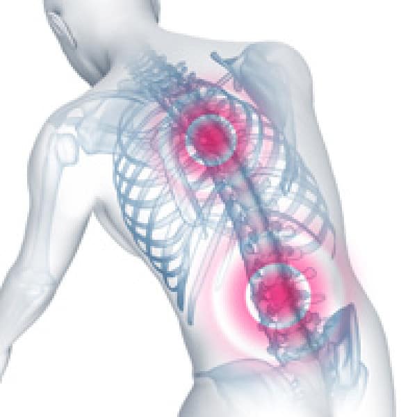 bad posture osteoporosis