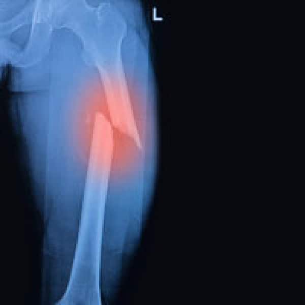 bisphophonates broken femur