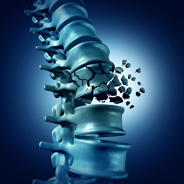 Alert! Study Confirms Bisphosphonates Worsen Bone Quality study confirms bisphosphonates worsen bone quality
